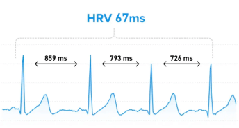 心率变异性示意图